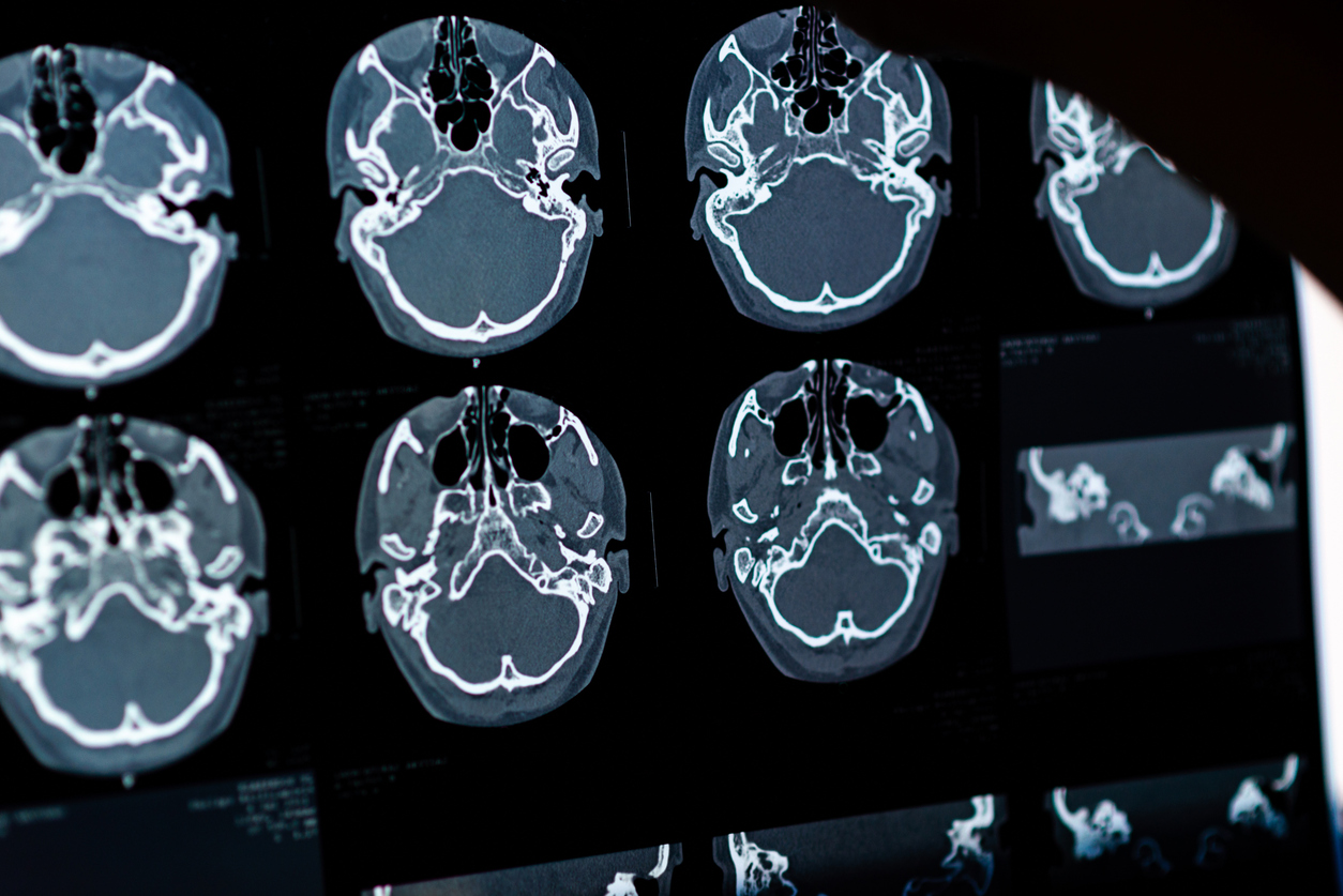 brain ct scan x ray film image brain