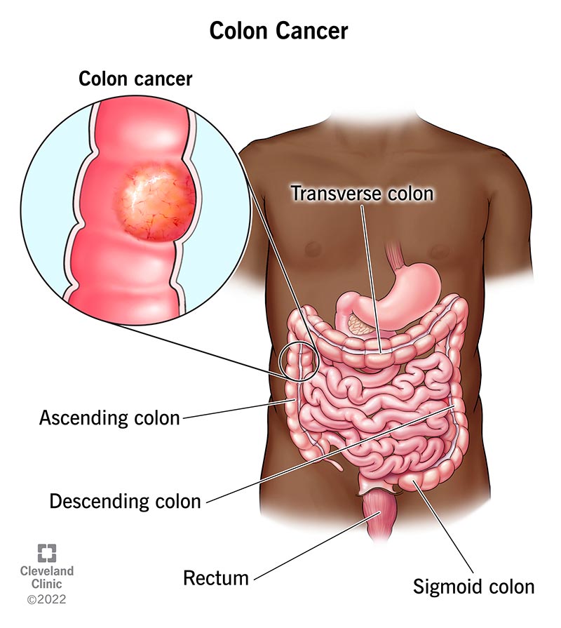 Colon cancer starts as polyps in your colon. It can start in any part of your colon.