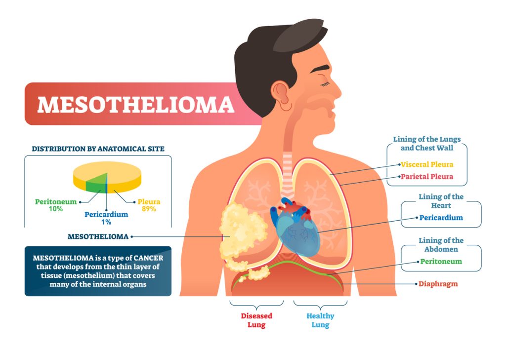 Shifting Regulatory Landscapes: New Legal Challenges for Mesothelioma Victims