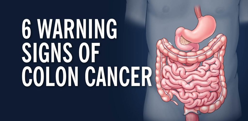 Understanding Colon Cancer: Facts, Statistics, and Survival Rates